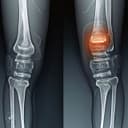 Knee Replacement